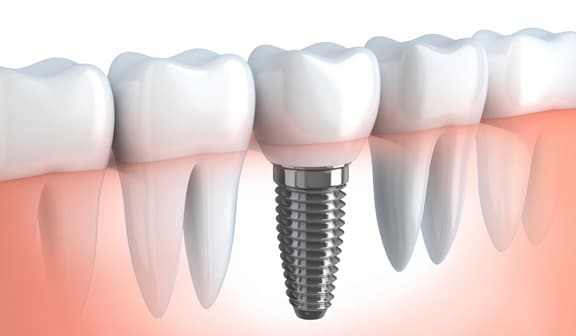 dental implant dentists Warrington
