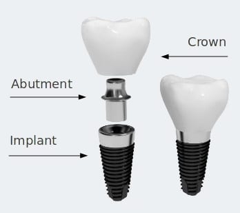 dental implants Oreland