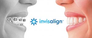 4 Invisalign™ Facts to Know
