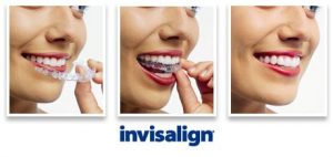 Get Your Smile Back with Invisalign™